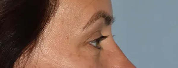 Eyelid Lift Before & After Gallery - Patient 17338158 - Image 9