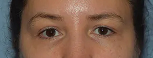 Eyelid Lift Before & After Gallery - Patient 17338159 - Image 1