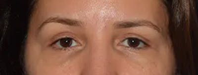 Eyelid Lift Before & After Gallery - Patient 17338159 - Image 2
