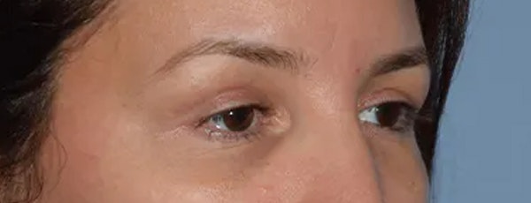 Eyelid Lift Before & After Gallery - Patient 17338159 - Image 4
