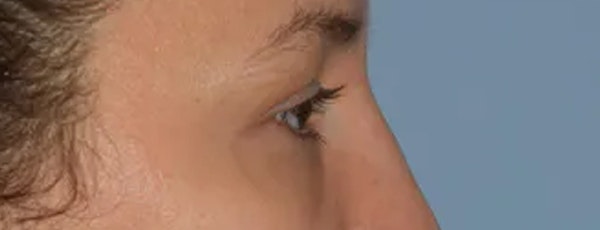 Eyelid Lift Before & After Gallery - Patient 17338159 - Image 5