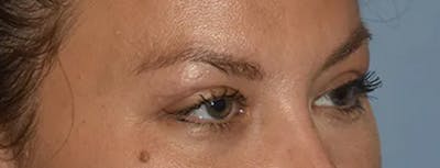 Eyelid Lift Before & After Gallery - Patient 17338157 - Image 4