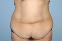 Tummy Tuck Before & After Gallery - Patient 6389681 - Image 1