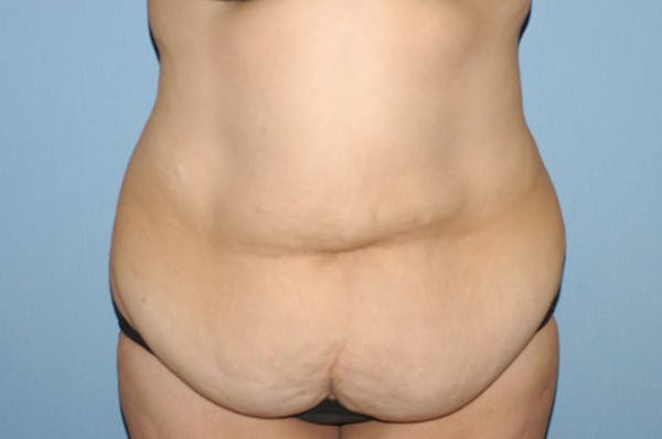 Tummy Tuck Gallery - Patient 6389681 - Image 1