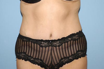 Tummy Tuck Before & After Gallery - Patient 6389681 - Image 2