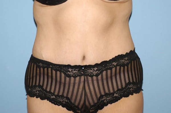 Tummy Tuck Before & After Gallery - Patient 6389681 - Image 2
