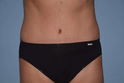Tummy Tuck Before & After Gallery - Patient 6389686 - Image 2