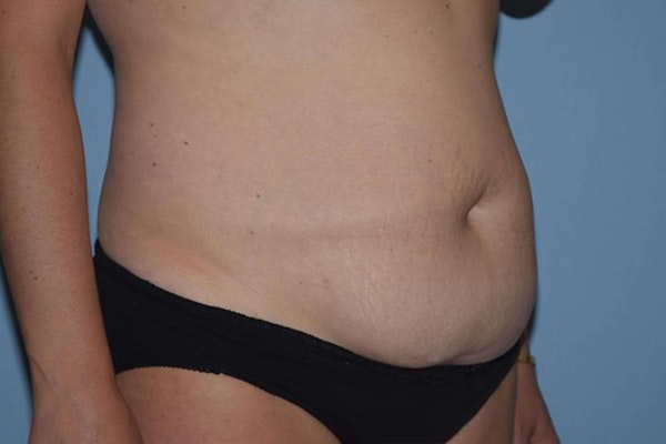 Tummy Tuck Before & After Gallery - Patient 6389686 - Image 3