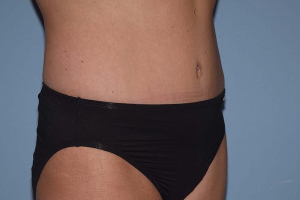 Tummy Tuck Before & After Gallery - Patient 6389686 - Image 4