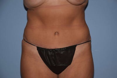 Tummy Tuck Before & After Gallery - Patient 6389687 - Image 2