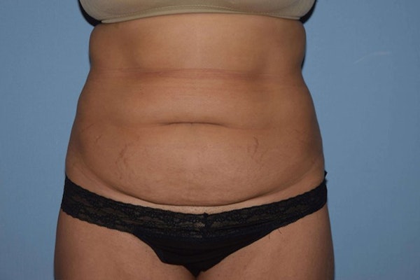 Tummy Tuck Before & After Gallery - Patient 6389687 - Image 1