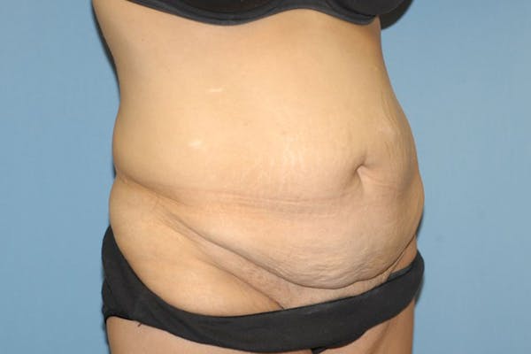 Tummy Tuck Before & After Gallery - Patient 6389677 - Image 3