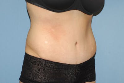 Tummy Tuck Before & After Gallery - Patient 6389677 - Image 4