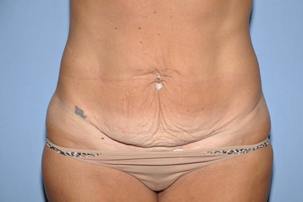 Tummy Tuck Before & After Gallery - Patient 6389680 - Image 1