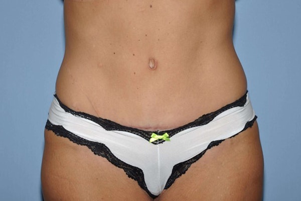 Tummy Tuck Before & After Gallery - Patient 6389680 - Image 2