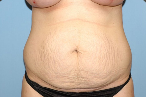 Tummy Tuck Before & After Gallery - Patient 9568143 - Image 1
