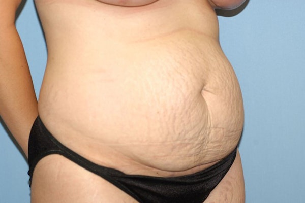 Tummy Tuck Before & After Gallery - Patient 9568143 - Image 3