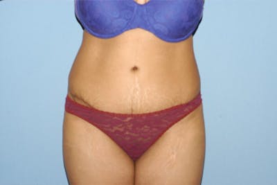 Tummy Tuck Before & After Gallery - Patient 6389678 - Image 2