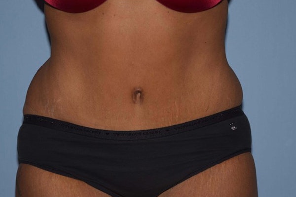 Tummy Tuck Before & After Gallery - Patient 6389683 - Image 2