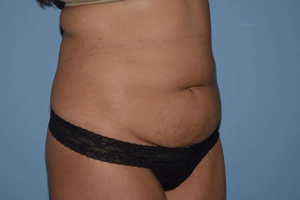 Tummy Tuck Before & After Gallery - Patient 6389687 - Image 3