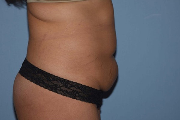 Tummy Tuck Before & After Gallery - Patient 6389687 - Image 5