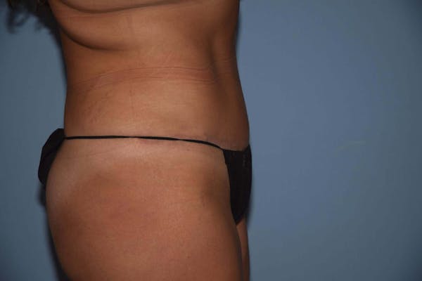 Tummy Tuck Before & After Gallery - Patient 6389687 - Image 6