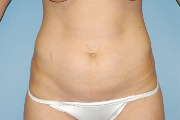 Tummy Tuck Before & After Gallery - Patient 6389690 - Image 1
