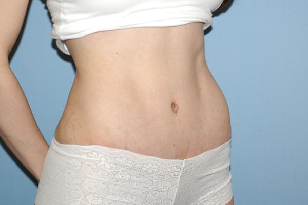 Tummy Tuck Gallery - Patient 6389690 - Image 4
