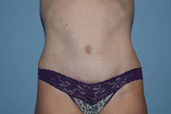 Tummy Tuck Before & After Gallery - Patient 6389691 - Image 2