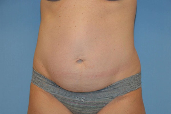 Tummy Tuck Before & After Gallery - Patient 6389691 - Image 1