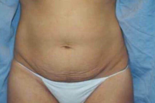 Tummy Tuck Before & After Gallery - Patient 9568111 - Image 1