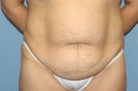 Tummy Tuck Before & After Gallery - Patient 9568116 - Image 1
