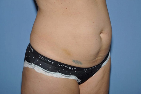 Tummy Tuck Before & After Gallery - Patient 9568124 - Image 3