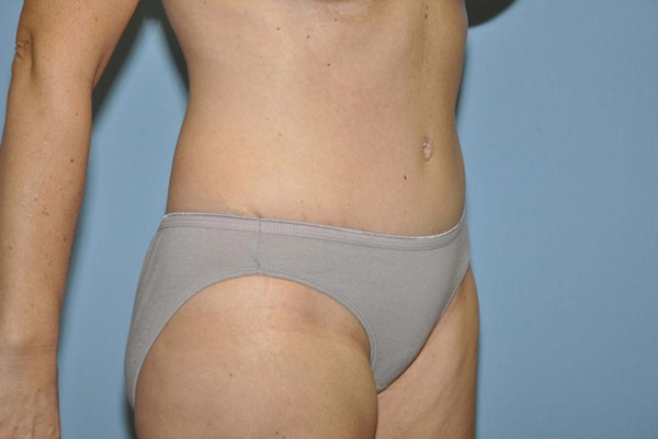 Tummy Tuck Before & After Gallery - Patient 9568124 - Image 4