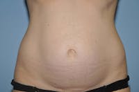 Tummy Tuck Before & After Gallery - Patient 9568128 - Image 1