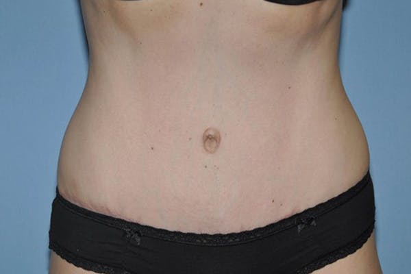Tummy Tuck Gallery - Patient 9568128 - Image 2