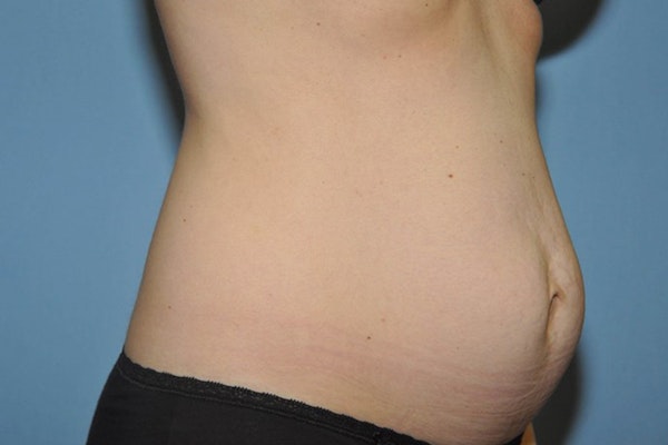 Tummy Tuck Before & After Gallery - Patient 9568128 - Image 3