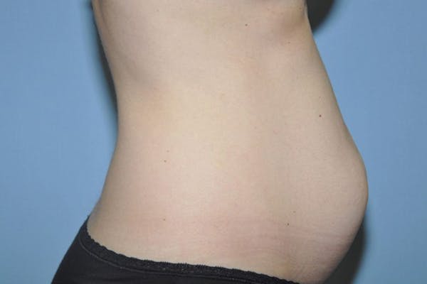 Tummy Tuck Gallery - Patient 9568128 - Image 5