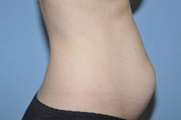 Tummy Tuck Before & After Gallery - Patient 9568128 - Image 5