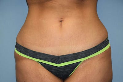 Tummy Tuck Before & After Gallery - Patient 9568130 - Image 2