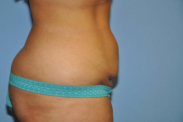 Tummy Tuck Before & After Gallery - Patient 9568130 - Image 3