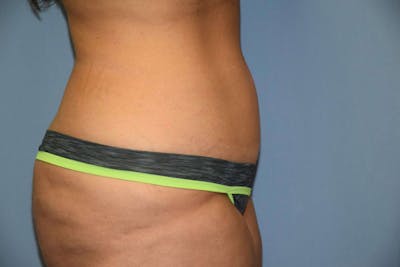 Tummy Tuck Before & After Gallery - Patient 9568130 - Image 4