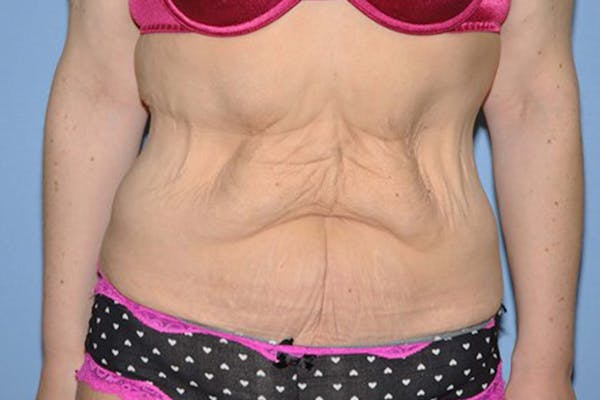 Tummy Tuck Before & After Gallery - Patient 9568136 - Image 1