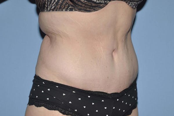 Tummy Tuck Before & After Gallery - Patient 9568136 - Image 4