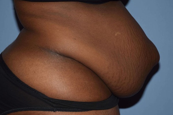 Tummy Tuck Before & After Gallery - Patient 9568140 - Image 5