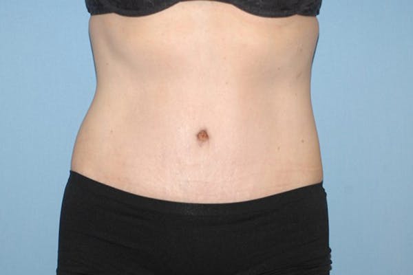 Tummy Tuck Before & After Gallery - Patient 9568141 - Image 2