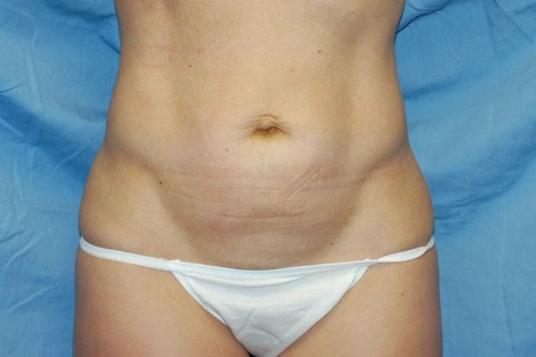 Tummy Tuck Before & After Gallery - Patient 9568142 - Image 1