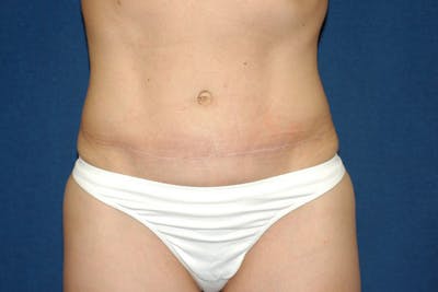 Tummy Tuck Before & After Gallery - Patient 9568142 - Image 2