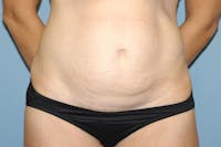 Tummy Tuck Before & After Gallery - Patient 9568145 - Image 1