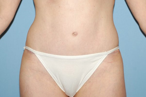 Tummy Tuck Before & After Gallery - Patient 9568145 - Image 2